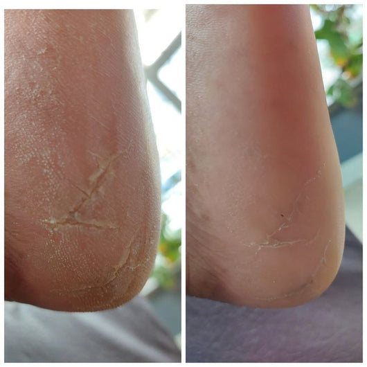 Feetee™ 3.0 Callus Remover