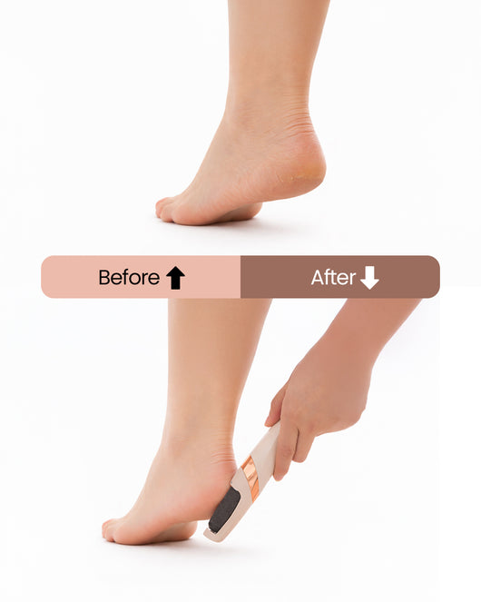 Feetee™ 3.0 Callus Remover