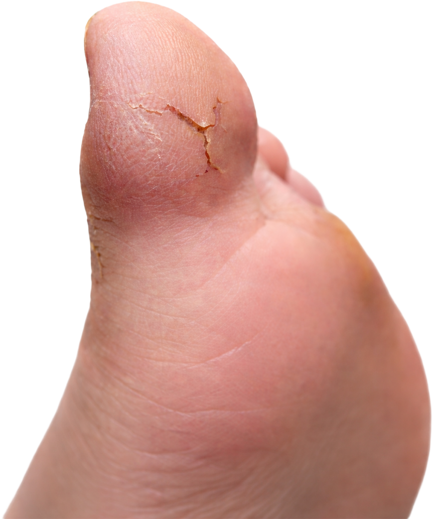 Calluses