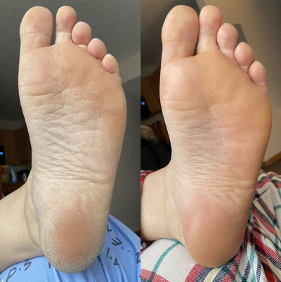 Feetee™ 3.0 Callus Remover