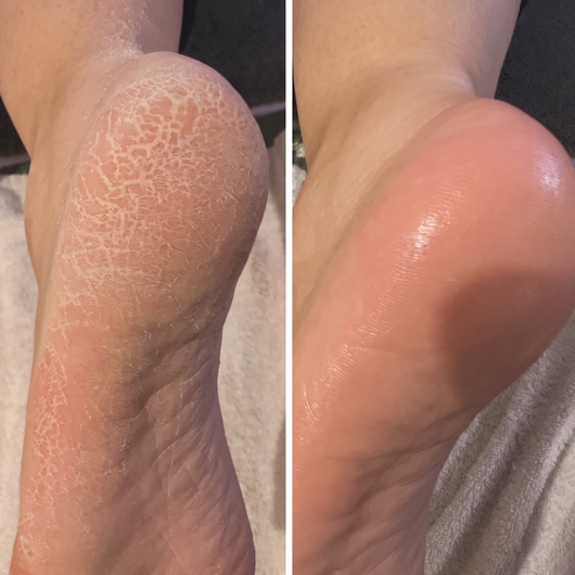 Feetee™ 3.0 Callus Remover